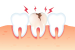 urgence-dent-cassee-differentes-sortes-de-fractures-et-leur-traitement-dentiste-colombes