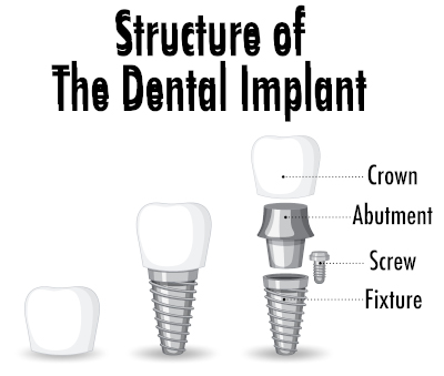 implant unitaire dentiste colombes